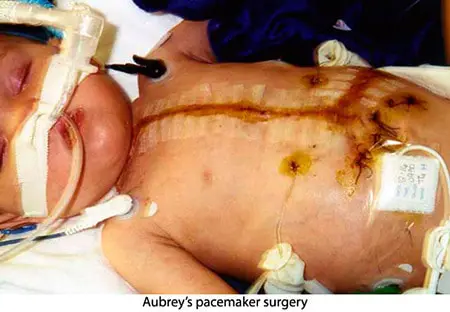 A baby with an incision on its chest.